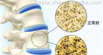 防治骨质疏松不止有“钙”